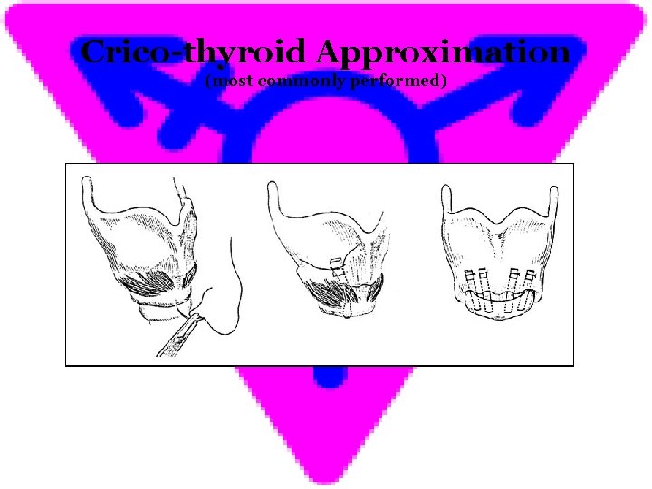Crico-thyroid Approximation (most commonly performed) 
