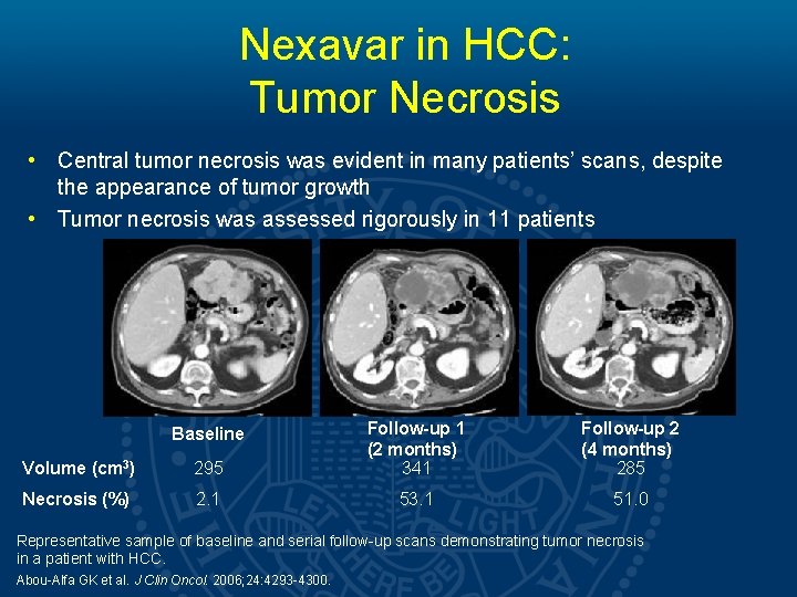 Nexavar in HCC: Tumor Necrosis • Central tumor necrosis was evident in many patients’