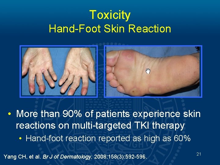 Toxicity Hand-Foot Skin Reaction • More than 90% of patients experience skin reactions on