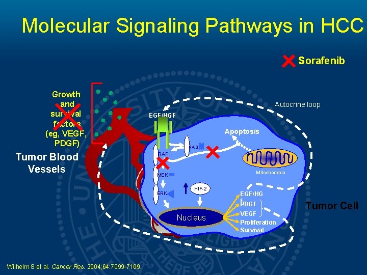 Molecular Signaling Pathways in HCC Sorafenib Growth and survival factors (eg, VEGF, PDGF) Tumor