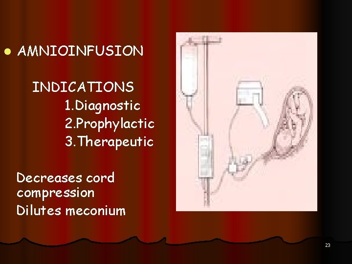 l AMNIOINFUSION INDICATIONS 1. Diagnostic 2. Prophylactic 3. Therapeutic Decreases cord compression Dilutes meconium