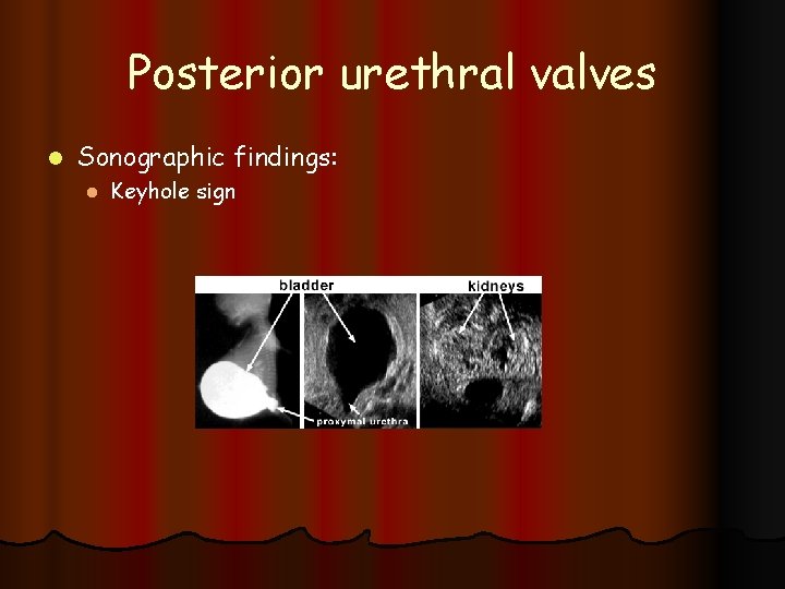 Posterior urethral valves l Sonographic findings: l Keyhole sign 
