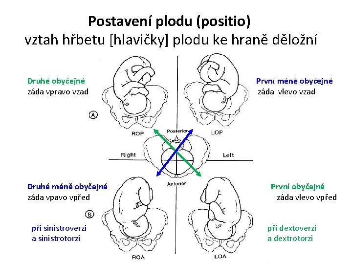 Postavení plodu (positio) vztah hřbetu [hlavičky] plodu ke hraně děložní Druhé obyčejné záda vpravo