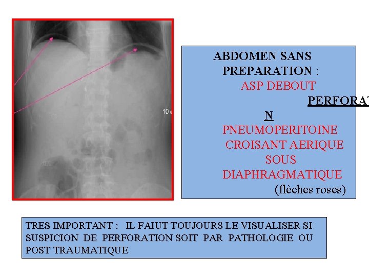 ABDOMEN SANS PREPARATION : ASP DEBOUT PERFORAT N PNEUMOPERITOINE CROISANT AERIQUE SOUS DIAPHRAGMATIQUE (flèches