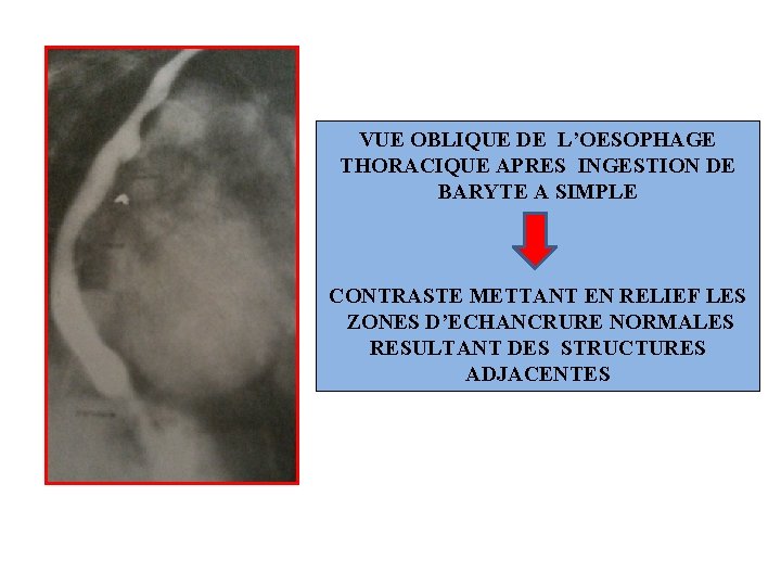 VUE OBLIQUE DE L’OESOPHAGE THORACIQUE APRES INGESTION DE BARYTE A SIMPLE CONTRASTE METTANT EN