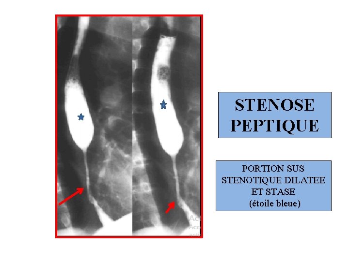 STENOSE PEPTIQUE PORTION SUS STENOTIQUE DILATEE ET STASE (étoile bleue) 