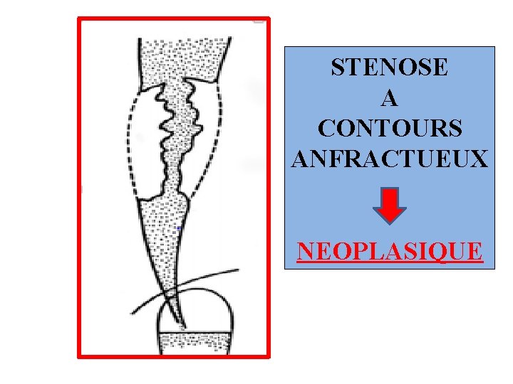 STENOSE A CONTOURS ANFRACTUEUX NEOPLASIQUE 