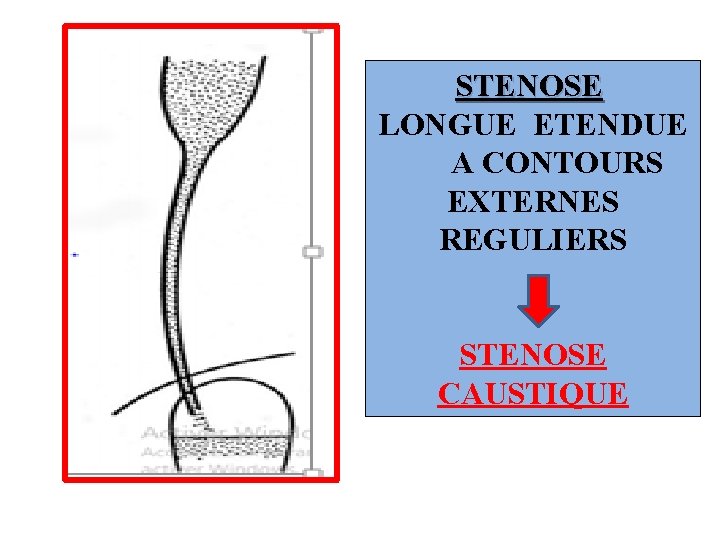 STENOSE LONGUE ETENDUE A CONTOURS EXTERNES REGULIERS STENOSE CAUSTIQUE 