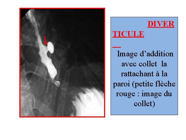 DIVER TICULE Image d’addition avec collet la rattachant à la paroi (petite flèche rouge