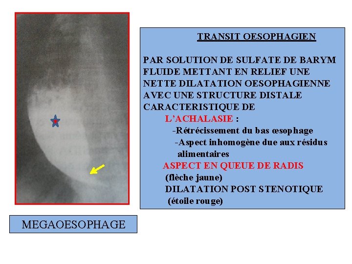 TRANSIT OESOPHAGIEN PAR SOLUTION DE SULFATE DE BARYM FLUIDE METTANT EN RELIEF UNE NETTE