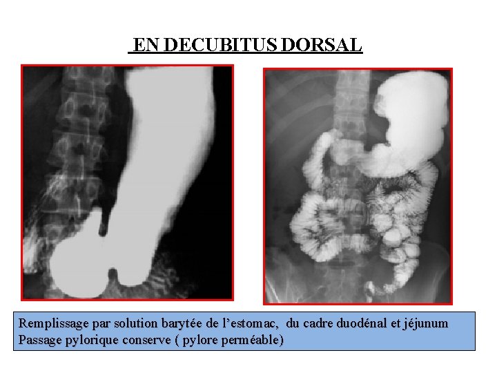 EN DECUBITUS DORSAL Remplissage par solution barytée de l’estomac, du cadre duodénal et jéjunum