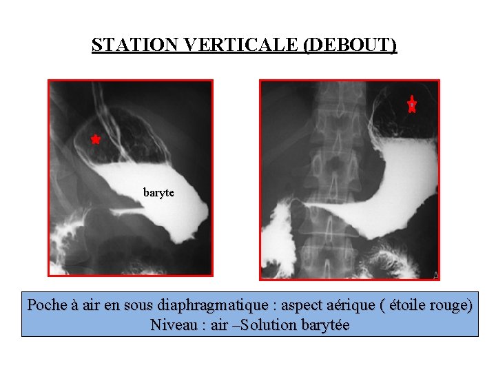 STATION VERTICALE (DEBOUT) baryte Poche à air en sous diaphragmatique : aspect aérique (