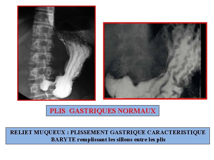 PLIS GASTRIQUES NORMAUX RELIET MUQUEUX : PLISSEMENT GASTRIQUE CARACTERISTIQUE BARYTE remplissant les sillons entre