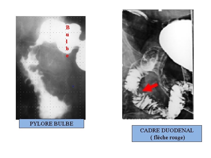 B u l b e PYLORE BULBE CADRE DUODENAL ( flèche rouge) 