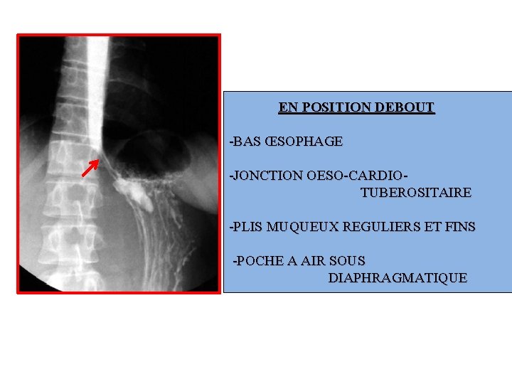 EN POSITION DEBOUT -BAS ŒSOPHAGE -JONCTION OESO-CARDIOTUBEROSITAIRE -PLIS MUQUEUX REGULIERS ET FINS -POCHE A