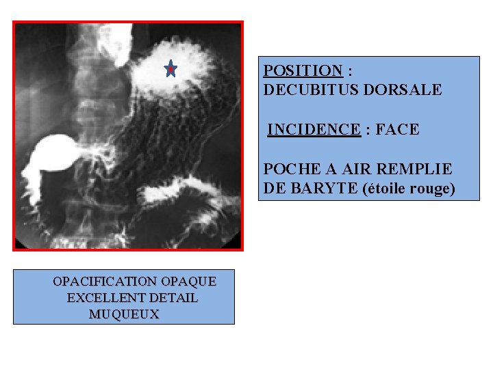 POSITION : DECUBITUS DORSALE INCIDENCE : FACE POCHE A AIR REMPLIE DE BARYTE (étoile