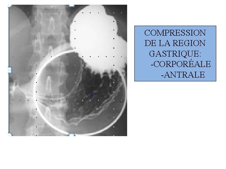 COMPRESSION DE LA REGION GASTRIQUE: -CORPORÉALE -ANTRALE 