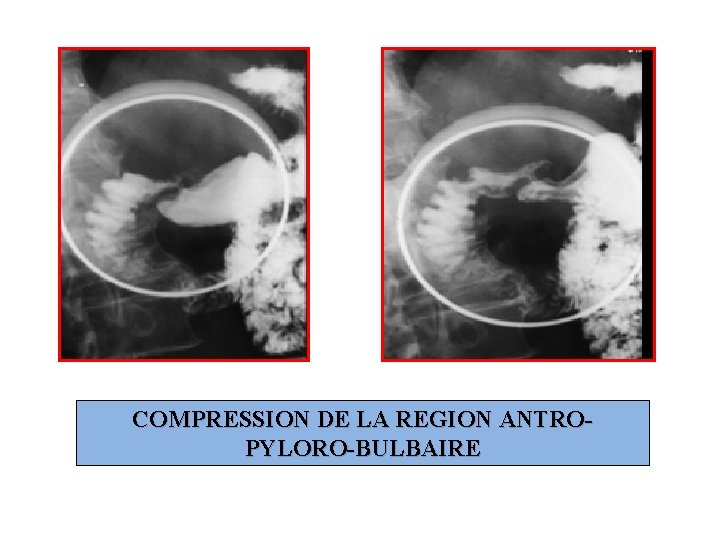 COMPRESSION DE LA REGION ANTROPYLORO-BULBAIRE 