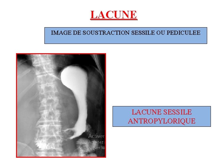 LACUNE IMAGE DE SOUSTRACTION SESSILE OU PEDICULEE LACUNE SESSILE ANTROPYLORIQUE 