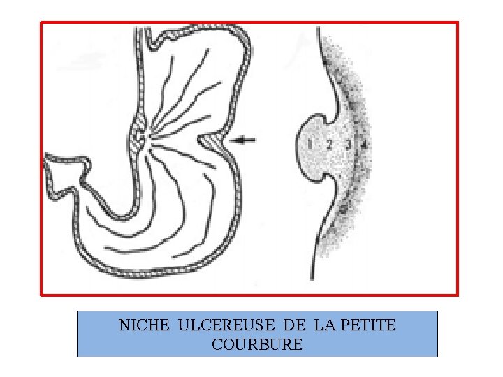 NICHE ULCEREUSE DE LA PETITE COURBURE 