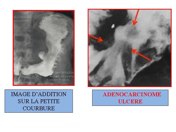 IMAGE D’ADDITION SUR LA PETITE COURBURE ADENOCARCINOME ULCERE 