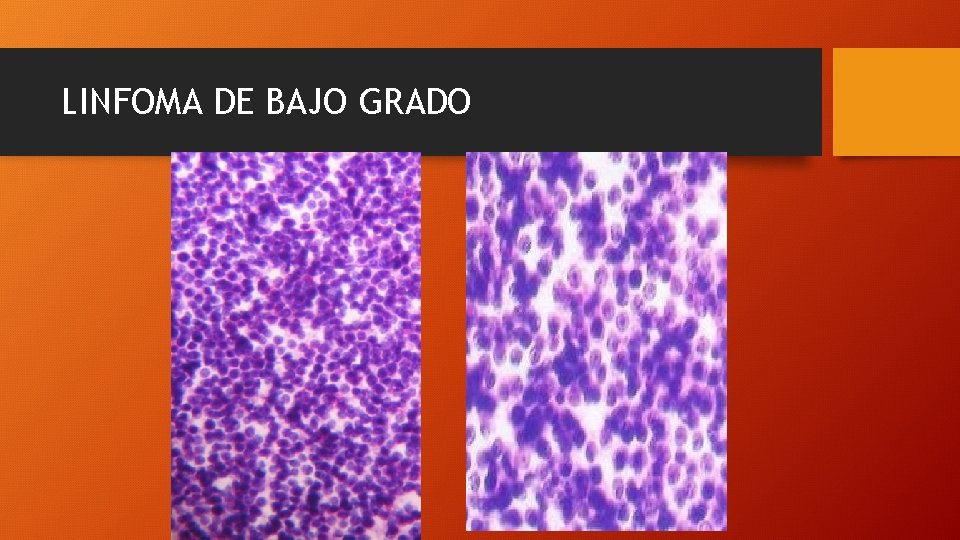LINFOMA DE BAJO GRADO 