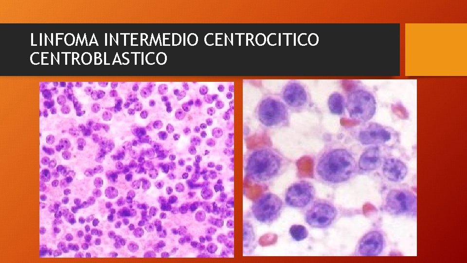 LINFOMA INTERMEDIO CENTROCITICO CENTROBLASTICO 