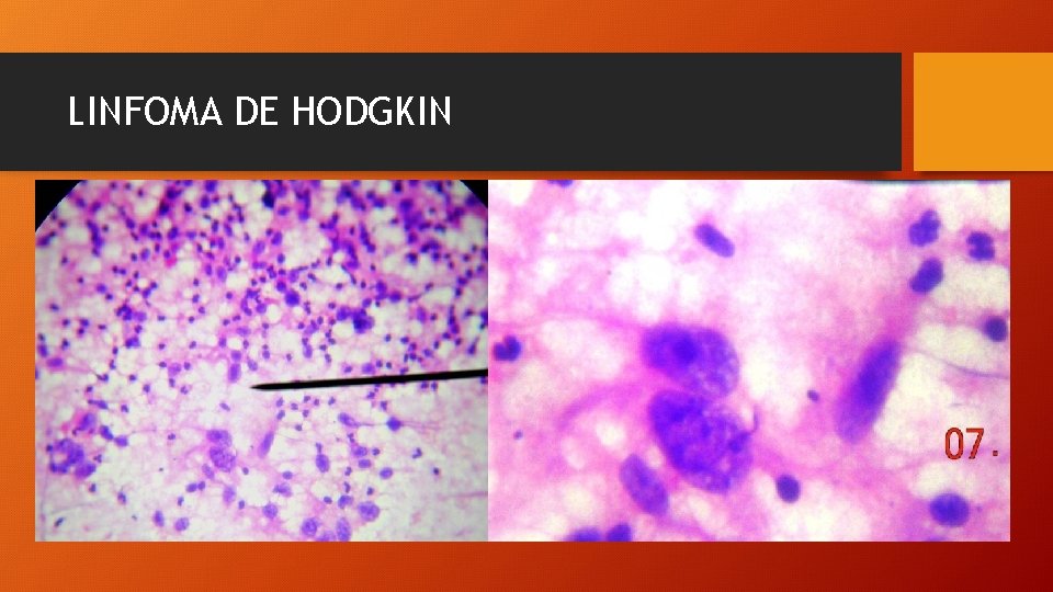 LINFOMA DE HODGKIN 