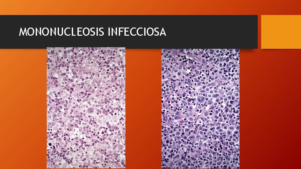 MONONUCLEOSIS INFECCIOSA 