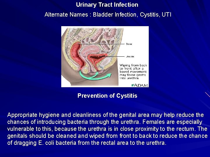 Urinary Tract Infection Alternate Names : Bladder Infection, Cystitis, UTI Prevention of Cystitis Appropriate