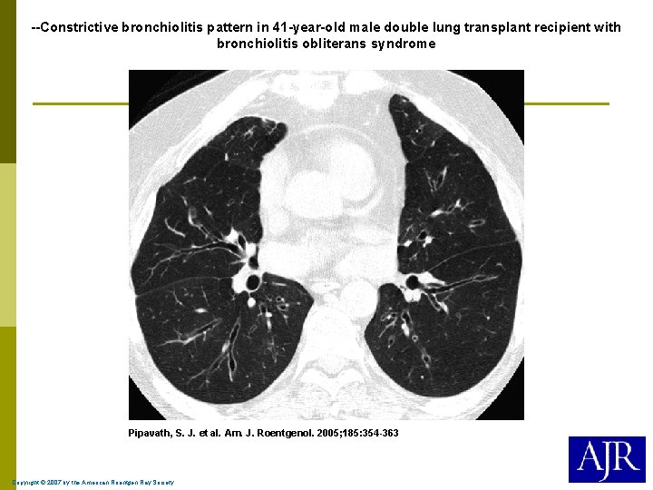 --Constrictive bronchiolitis pattern in 41 -year-old male double lung transplant recipient with bronchiolitis obliterans