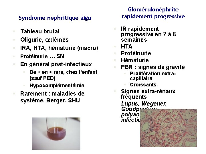 Syndrome néphritique aigu § Tableau brutal § Oligurie, œdèmes § IRA, HTA, hématurie (macro)