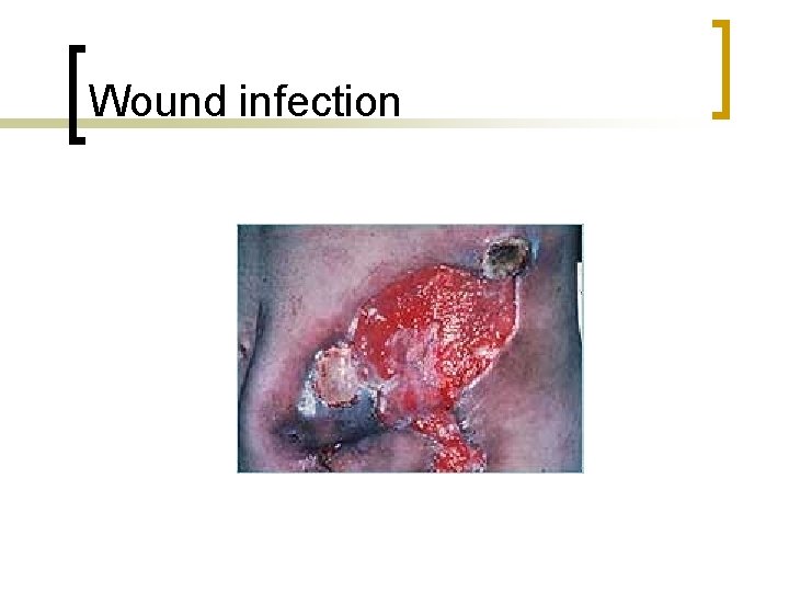 Wound infection 