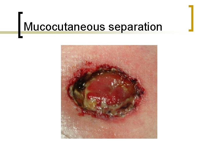 Mucocutaneous separation 