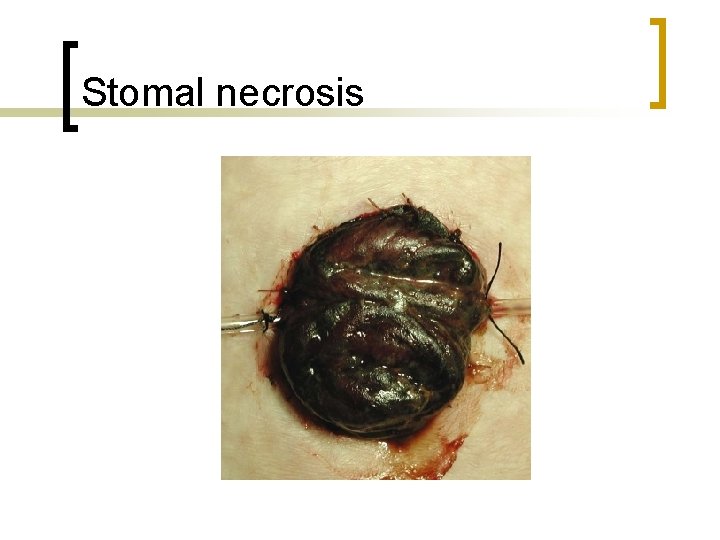 Stomal necrosis 