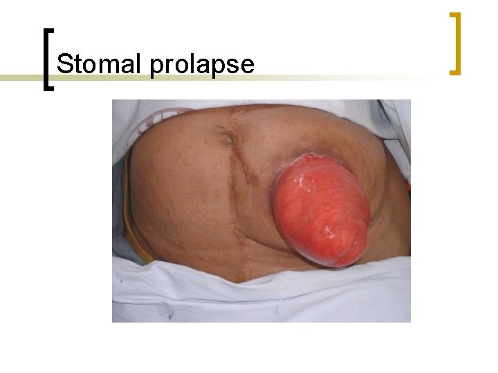 Stomal prolapse 