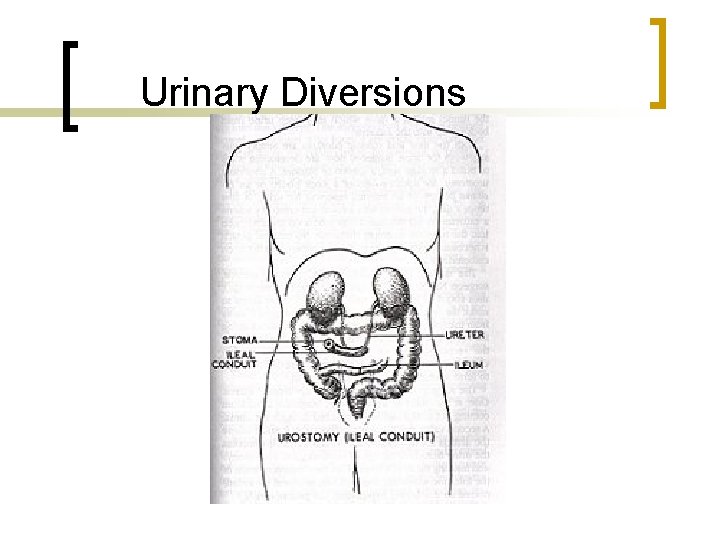 Urinary Diversions 