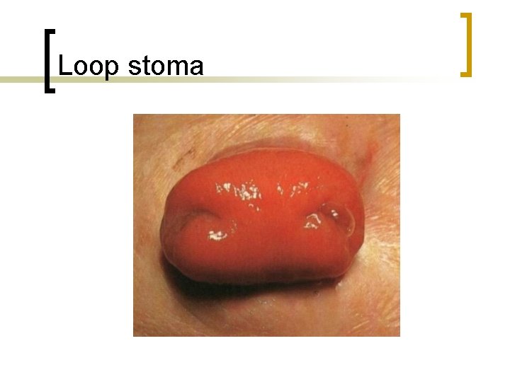 Loop stoma 