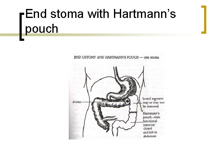 End stoma with Hartmann’s pouch 