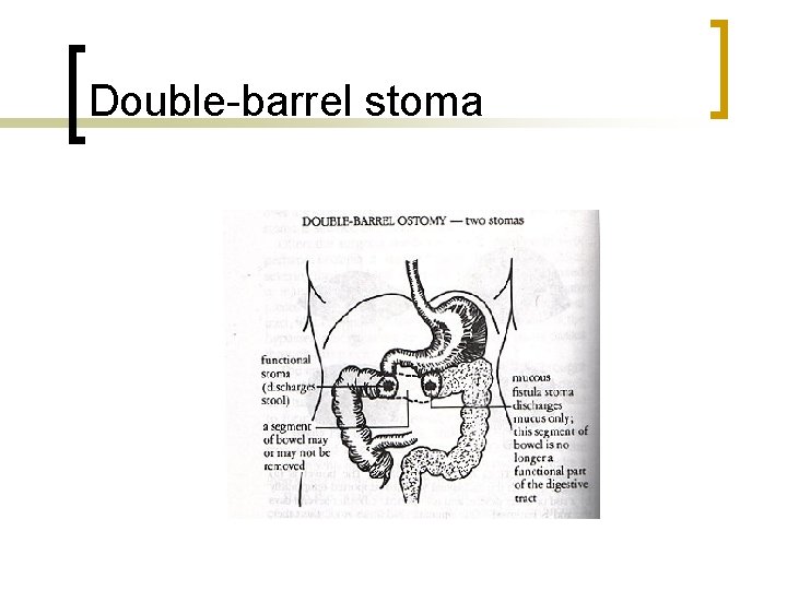 Double-barrel stoma 