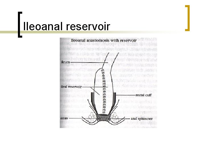 Ileoanal reservoir 