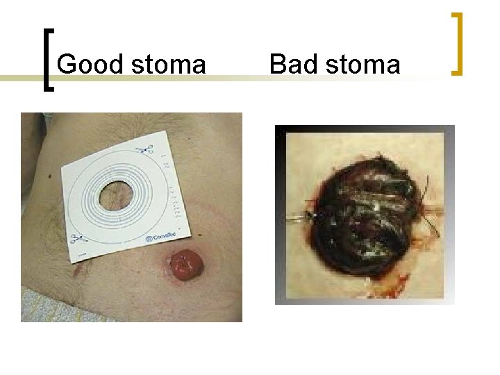 Good stoma Bad stoma 