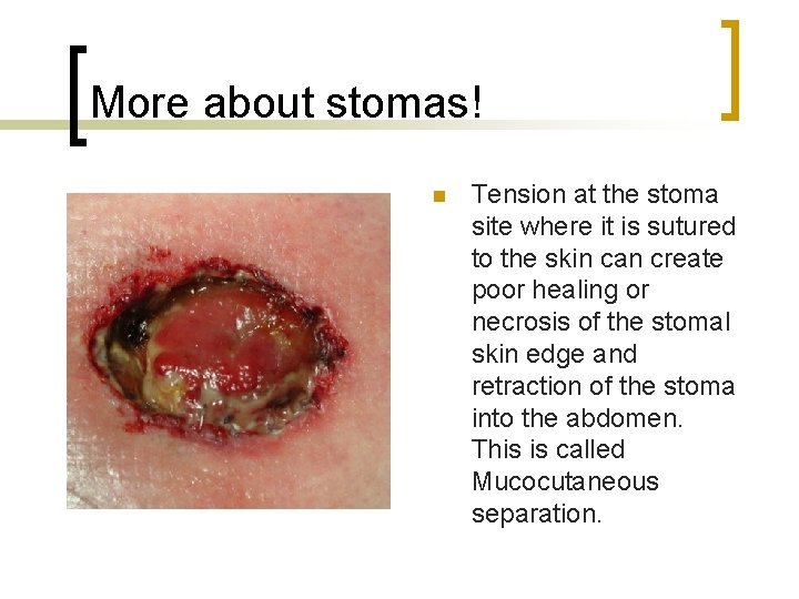 More about stomas! n Tension at the stoma site where it is sutured to