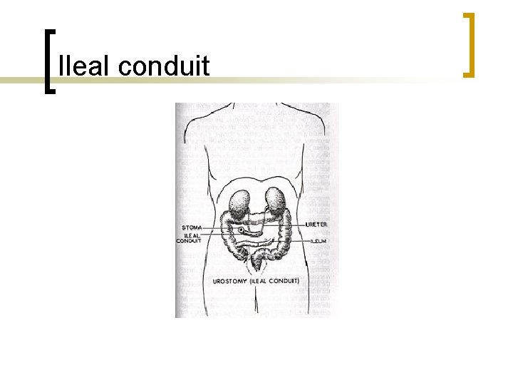 Ileal conduit 