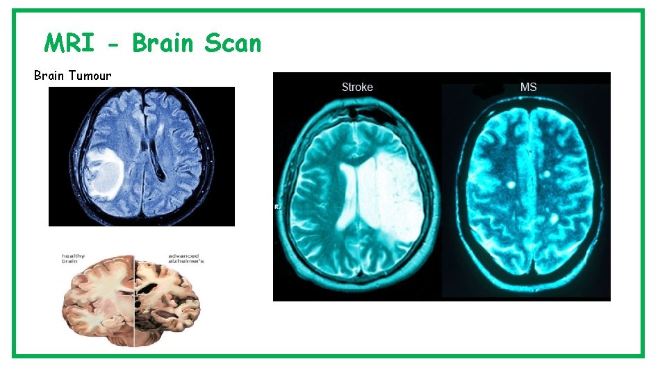 MRI - Brain Scan Brain Tumour 