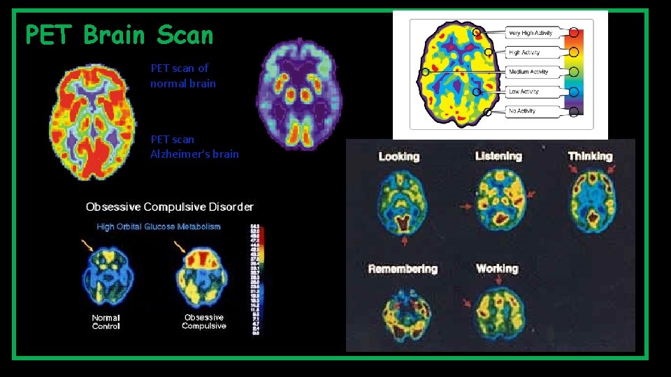 PET Brain Scan PET scan of normal brain PET scan Alzheimer’s brain 