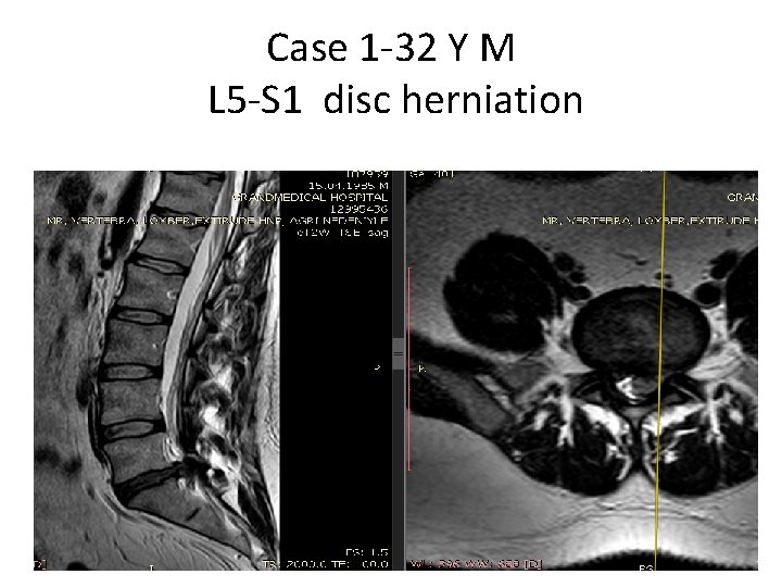 Case 1 -32 Y M L 5 -S 1 disc herniation 