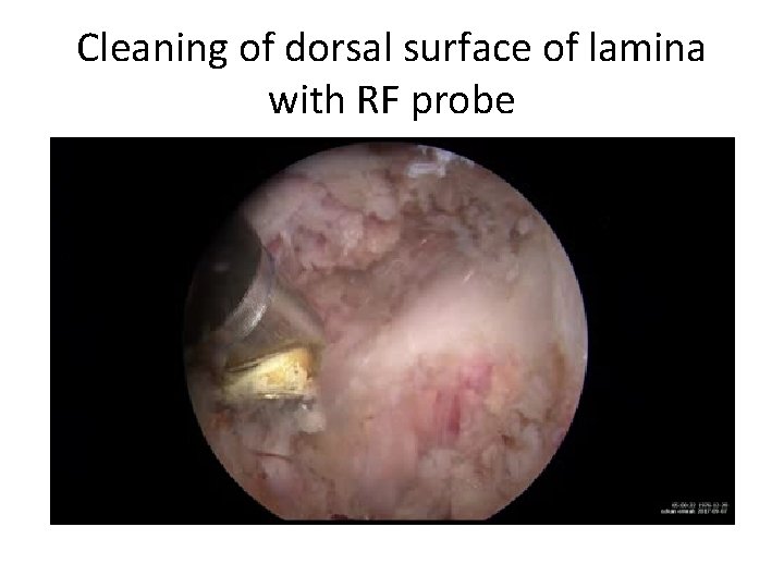 Cleaning of dorsal surface of lamina with RF probe 