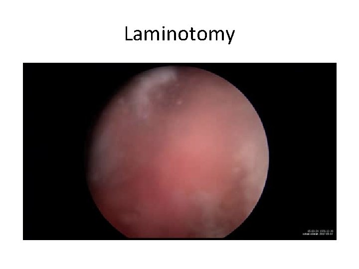 Laminotomy 