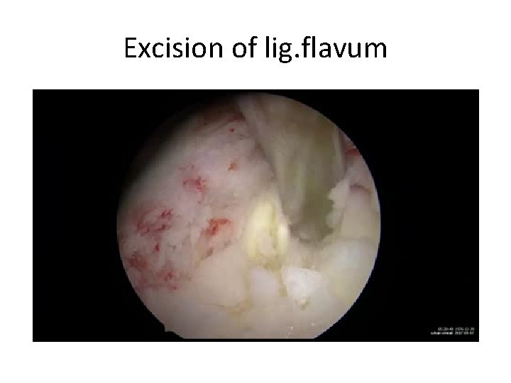 Excision of lig. flavum 